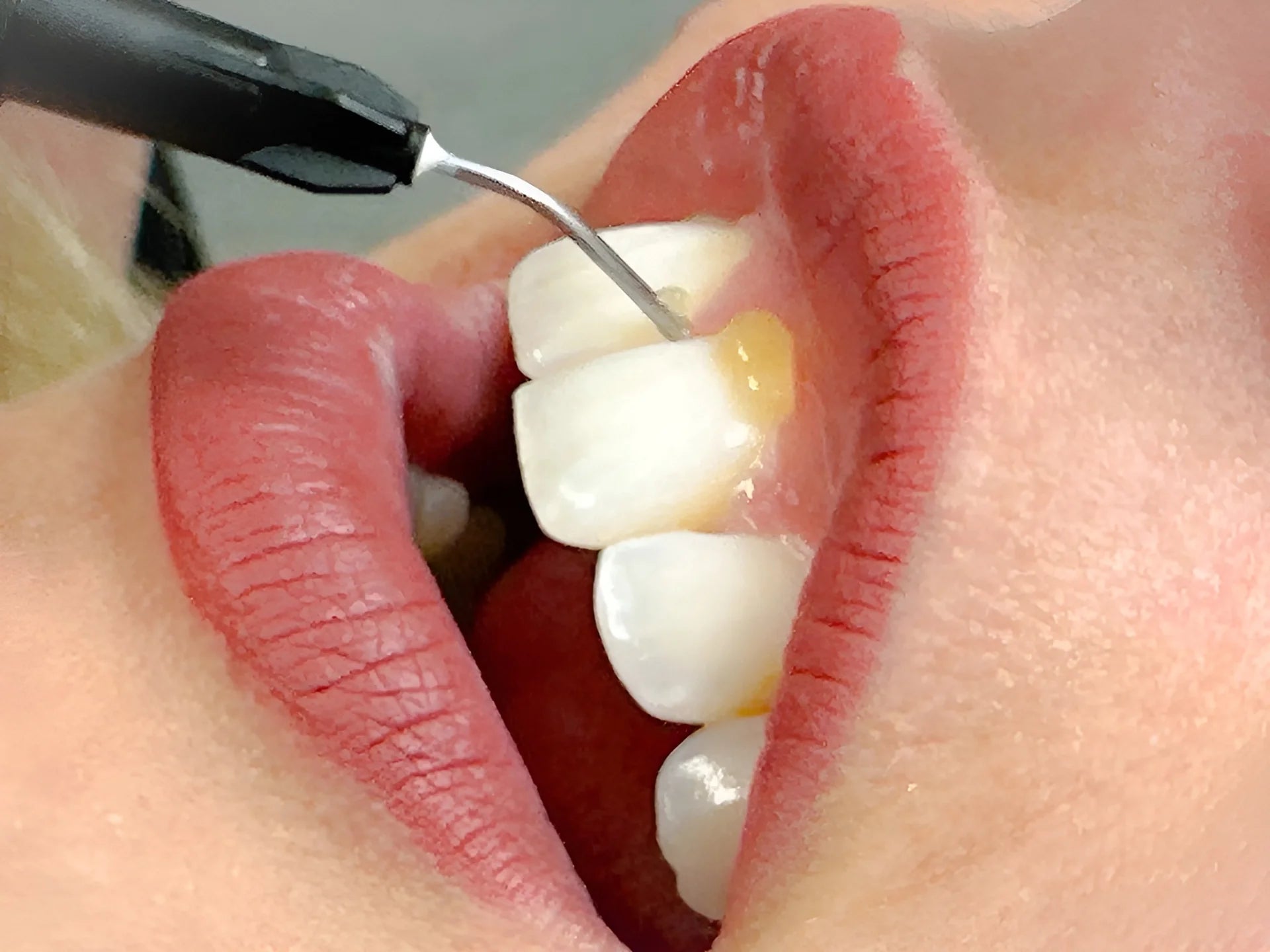 UPT – Unterstützende Parodontaltherapie & Entzündungsregulation