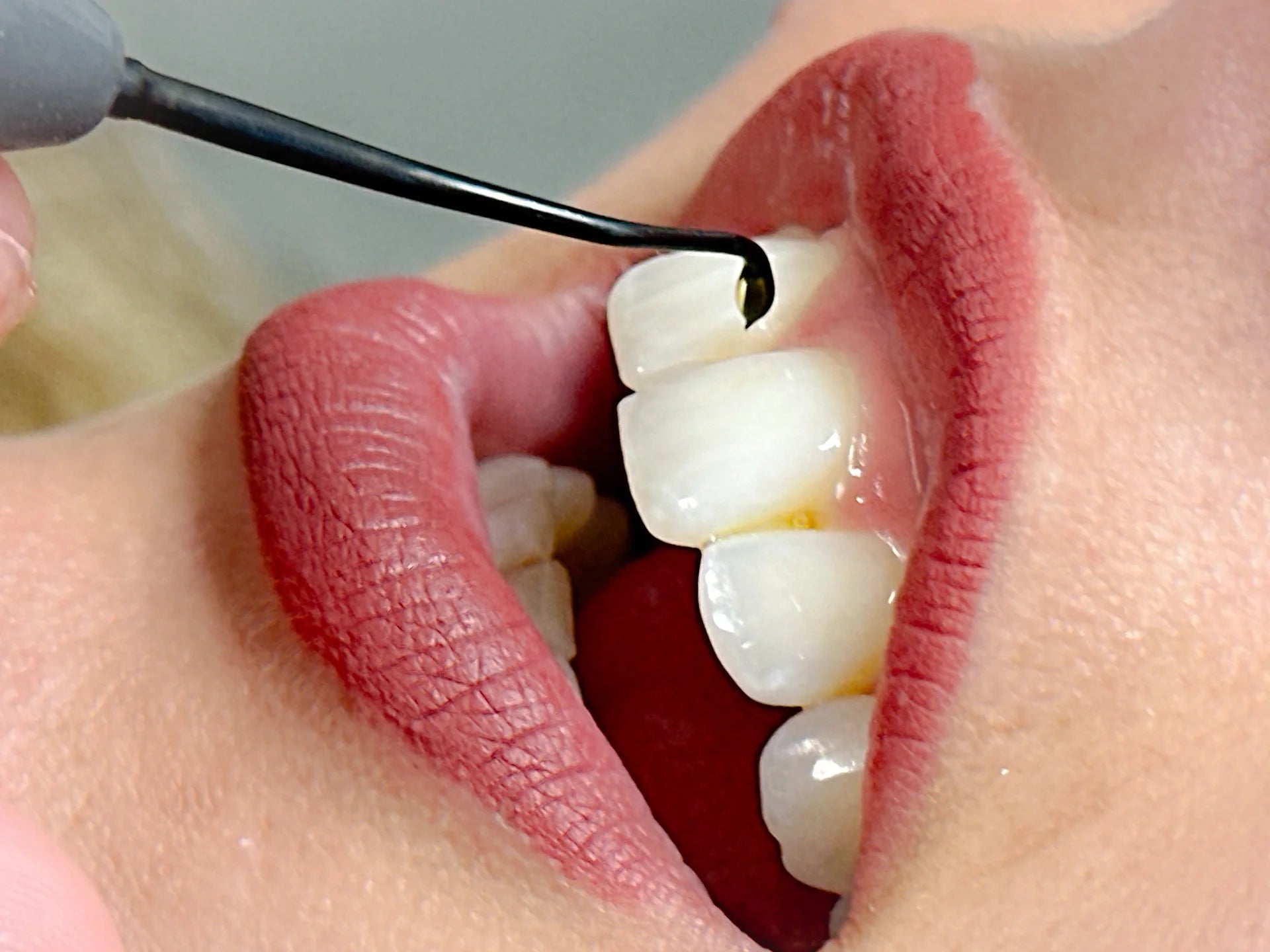 UPT ohne Entzündungsreaktion